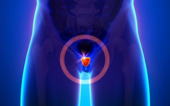 Είναι μια πολύ συχνή πάθηση, που πρακτικά θα απασχολήσει 1 στους 2 άντρες κατά τη διάρκεια της ζωής του