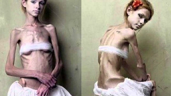 Νευρική ανορεξία: η μάστιγα του αιώνα