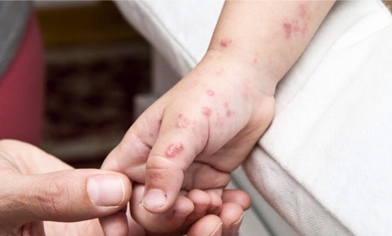 ΕΟΔΥ: Αύξηση περιστατικών Κοξάκι σε παιδιά και συστηνόμενα προληπτικά μέτρα 