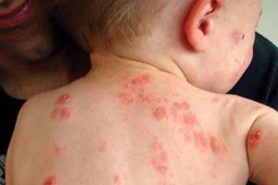 Κρούσματα ψώρας στο Διδυμότειχο