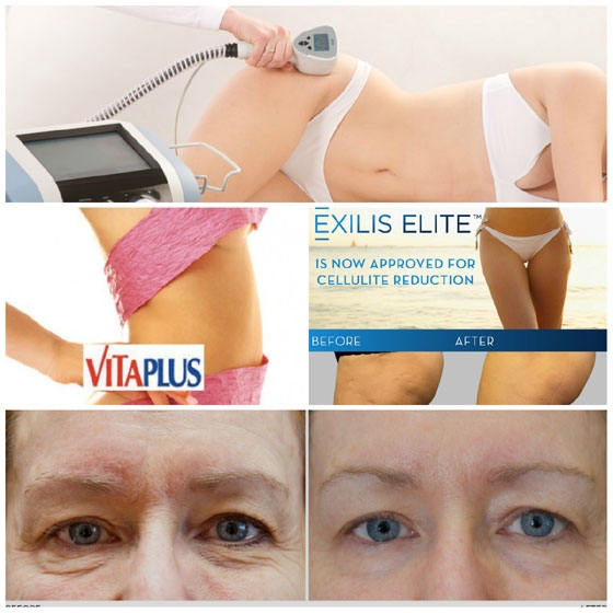 Vita Plus Αλεξανδρούπολης: Νέα τεχνολογία Exilis διαμόρφωσης σώματος και αντιγήρανσης προσώπου